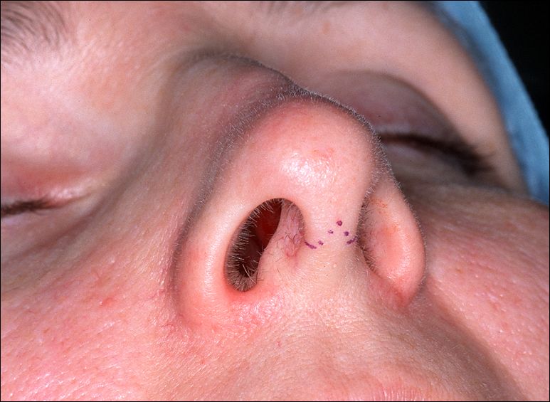 Rhinoplasty minor scars