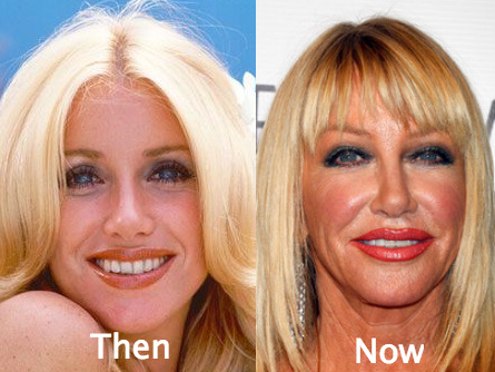 Suzanne Somers Awful Plastic Surgery