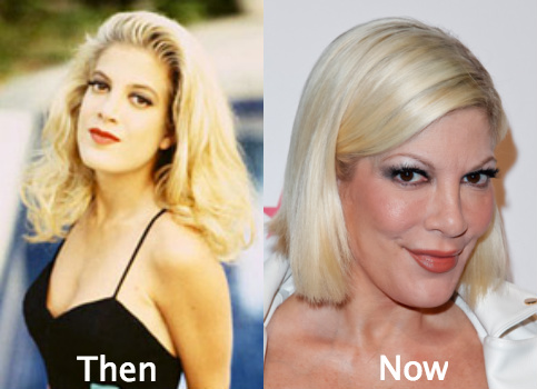 Tori Spelling Plastic Surgery Before and After