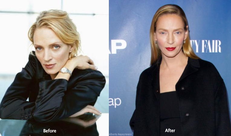 Uma Thurman before and after cosmetic surgery