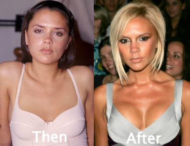 Victoria Beckham awful plastic surgery
