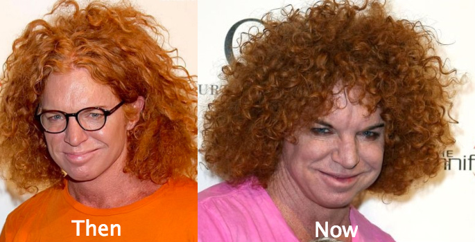 carrot top awful plastic surgery 