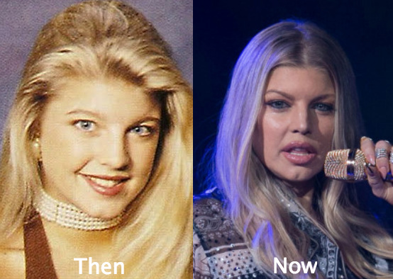 fergie awful plastic surgery