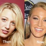 Blake Lively Plastic Surgery Before and After Photos – Nose Job