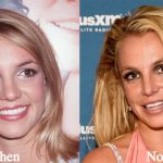 Britney Spears Plastic Surgery Before and After Photos