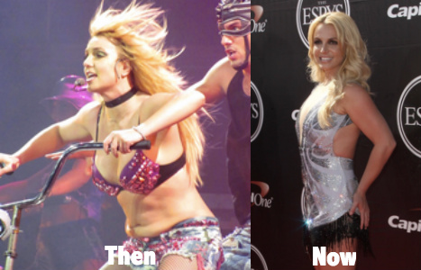 Britney Spears before and after possible liposuction