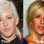 Ellie Goulding Plastic Surgery Before and After Photos