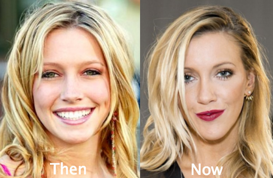 Katie Cassidy Plastic Surgery before and after photos