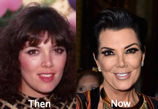 Kris Jenner admitted to plastic surgery