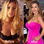Sofia Vergara Plastic Surgery Before and After Photos