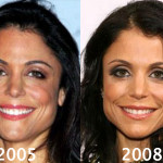 Bethenny Frankel Plastic Surgery Before and After Photos
