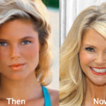 Christie Brinkley Plastic Surgery Before and After Photos