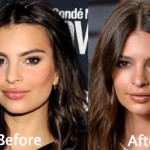 Emily Ratajkowski Plastic Surgery Before and After
