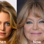 Goldie Hawn Plastic Surgery Before and After Photos