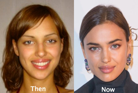 Irina Shayk Plastic Surgery before and after