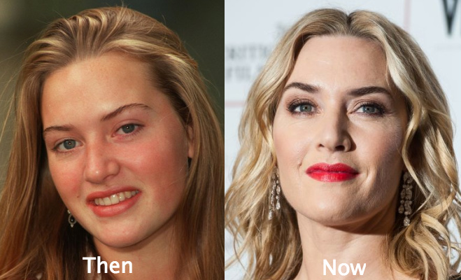 Kate Winslet Facelift before and after