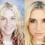 Kesha Plastic Surgery Before and After Photos