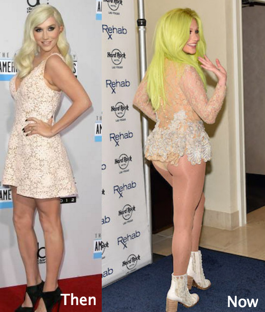 Did Kesha go for butt augmentation?