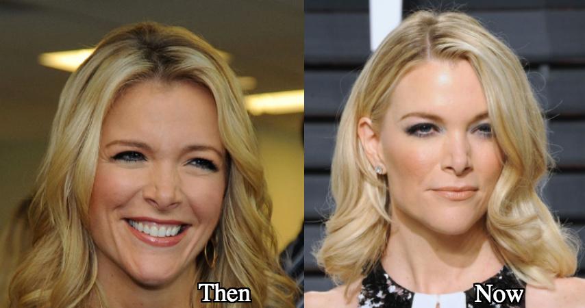Megyn Kelly before and after photos