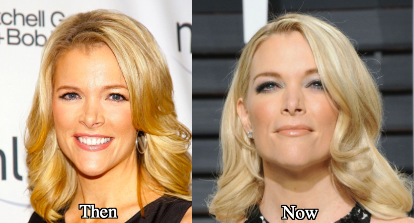 Megyn Kelly nose job surgery before and after