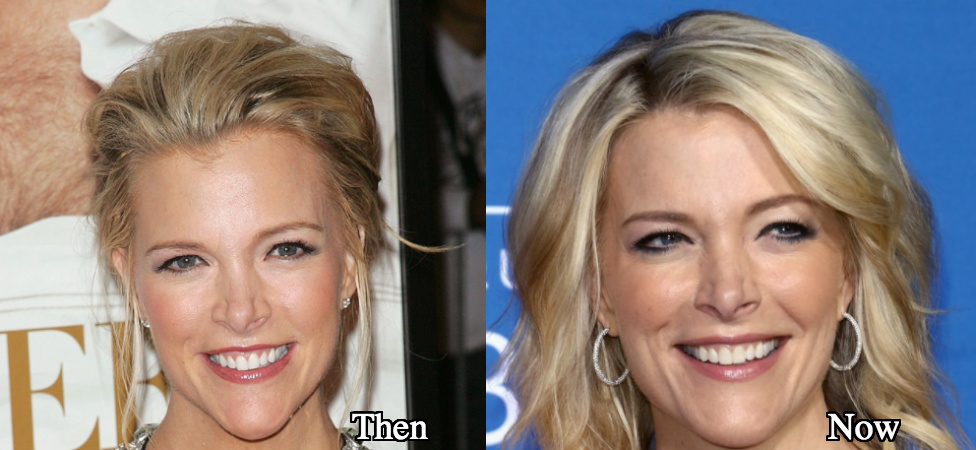 Megyn Kelly sharper nose job before and after photos