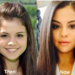 Selena Gomez Plastic Surgery Before and After Photos