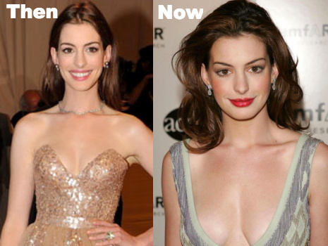Anne Hathaway boob job