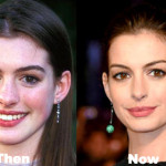 Anne Hathaway Plastic Surgery Before and After Photos