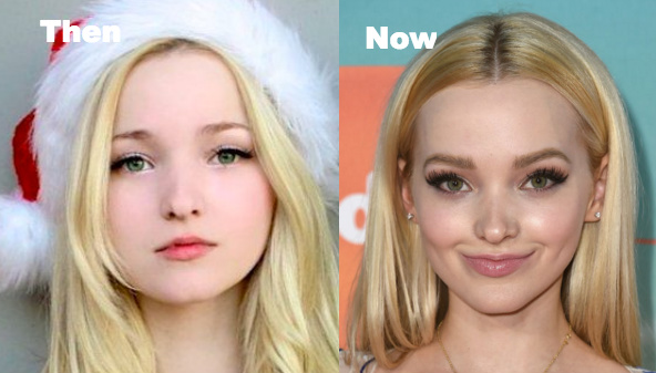 Dove Cameron Plastic Surgery before and after