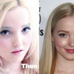 Dove Cameron Plastic Surgery Before and After Photos