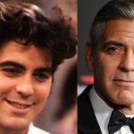 George Clooney Plastic Surgery Before and After Photos