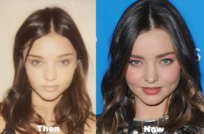 Miranda Kerr Plastic Surgery Before and After