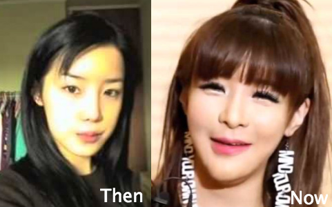 Park Bom Cosmetic Surgery before and after