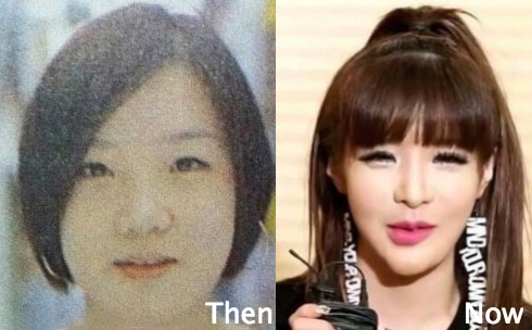Park Bom Plastic Surgery before and after photo