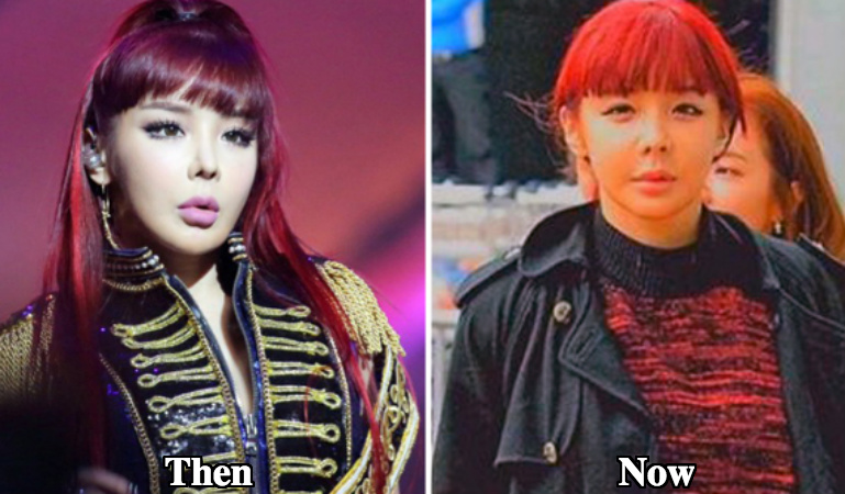 Park Bom Plastic Surgery before and after photos