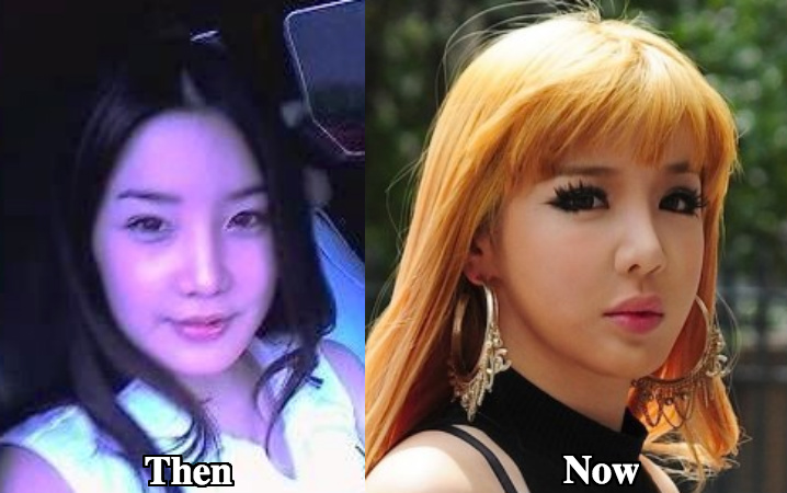 Park Bom lip fillers before and after photos