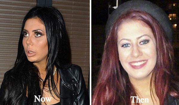 chloe ferry plastic surgery before and after