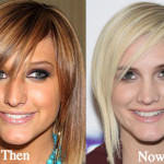 Ashlee Simpson Plastic Surgery Before and After Photos