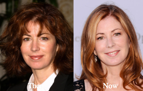 Dana Delany cosmetic surgery before and after photos
