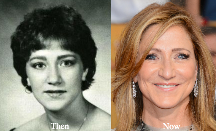 Edie Falco Plastic Surgery before and after photos