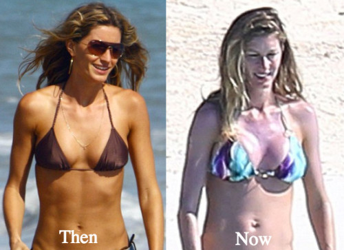 Gisele Bundchen Plastic Surgery Before And After Photos