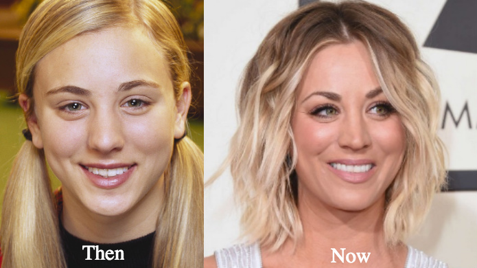 Kaley Cuoco Plastic Surgery before and after photos