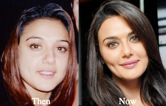 Preity Zinta Plastic Surgery before and after photos