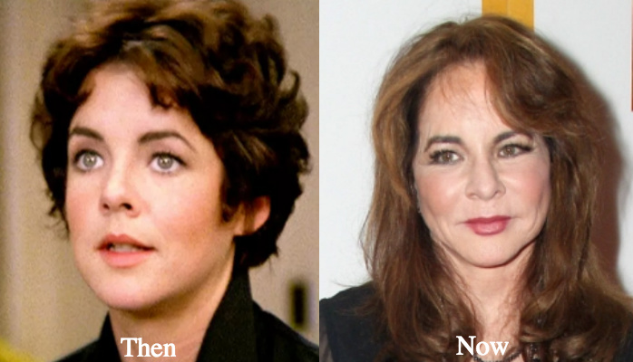 Stockard Channing nose job facelift and neck lift
