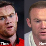 Wayne Rooney Plastic Surgery Before and After Botox