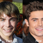 Zac Efron Plastic Surgery Before and After Photos