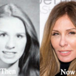Carole Radziwill Plastic Surgery Before and After Photos