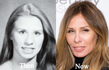 Carole Radziwill plastic surgery before and after photos