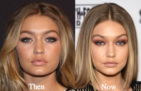Gigi Hadid Plastic Surgery before and after photos