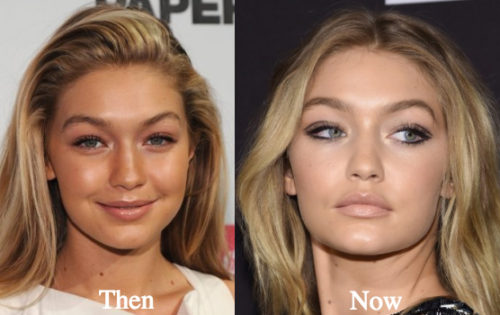 Gigi Hadid Plastic Surgery Before and After Photos